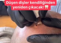 Dişlerin yeniden çıkması