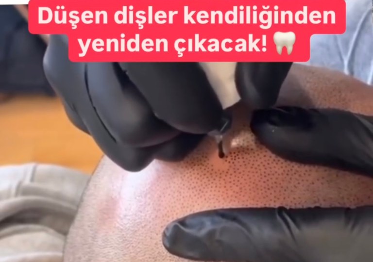 Dişlerin yeniden çıkması